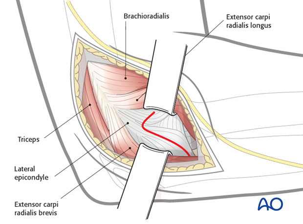 lateral approach