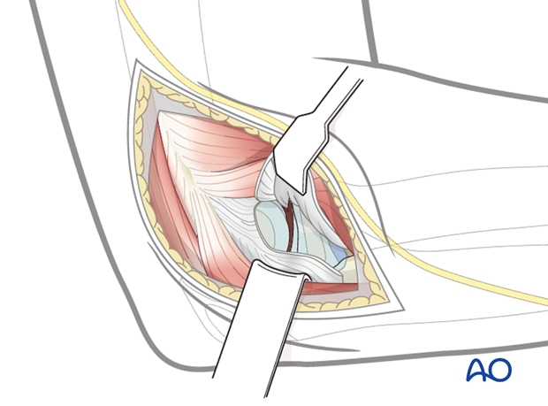 lateral approach