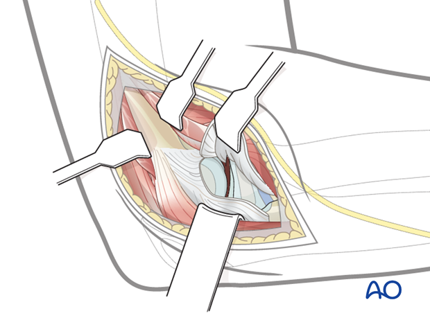 lateral approach