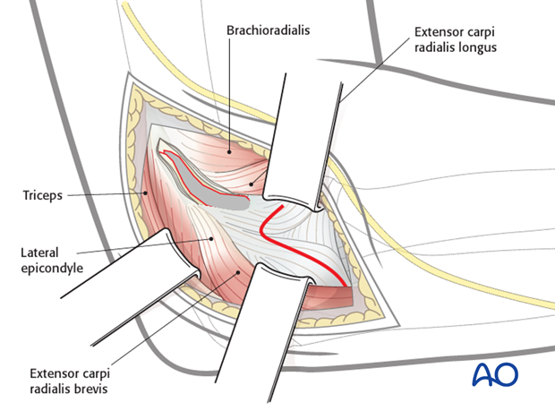 lateral approach