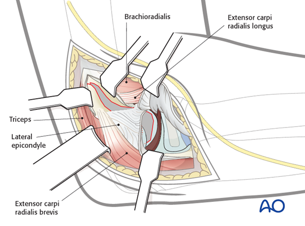 lateral approach