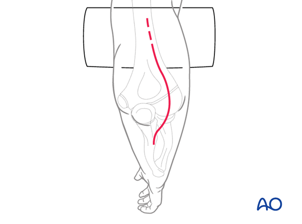 posterior approach without olecranon osteotomy