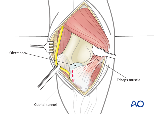 posterior approach without olecranon osteotomy