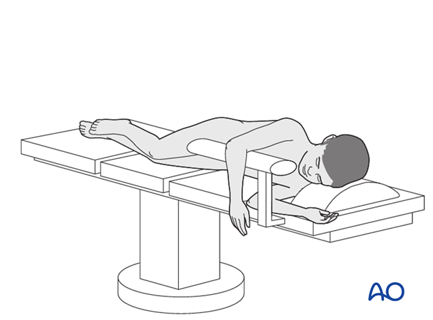 posterior approach without olecranon osteotomy