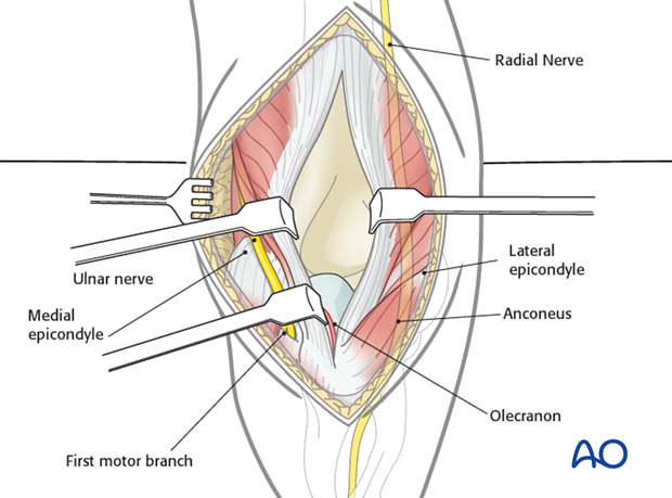 posterior approach without olecranon osteotomy