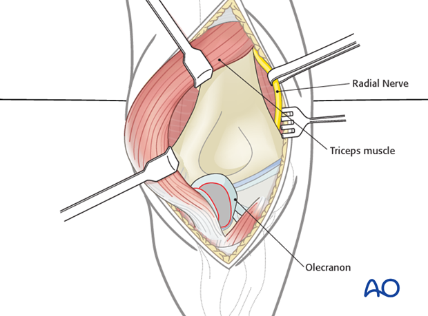 posterior approach without olecranon osteotomy