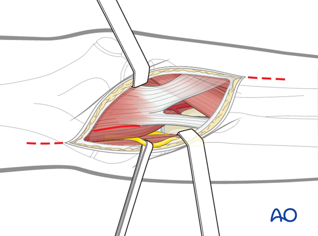 anterior approach