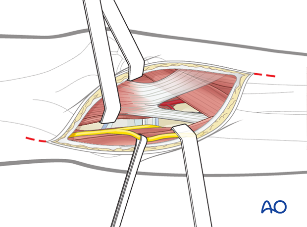 anterior approach