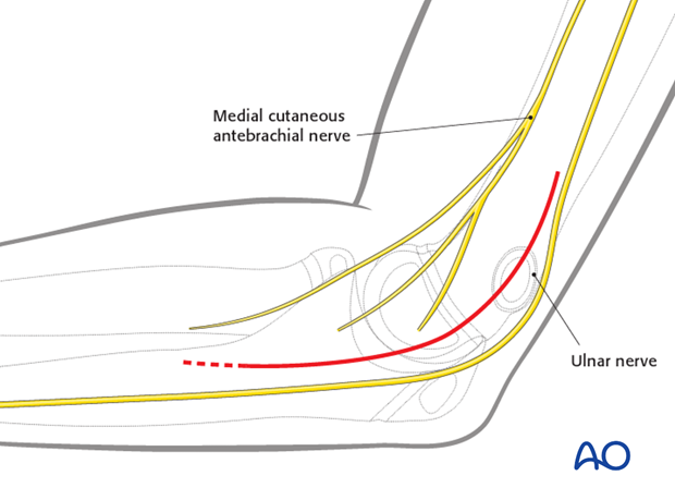 Medial approach