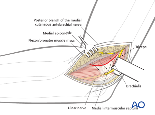 medial approach