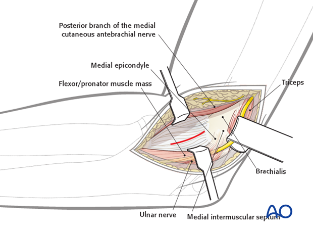 medial approach