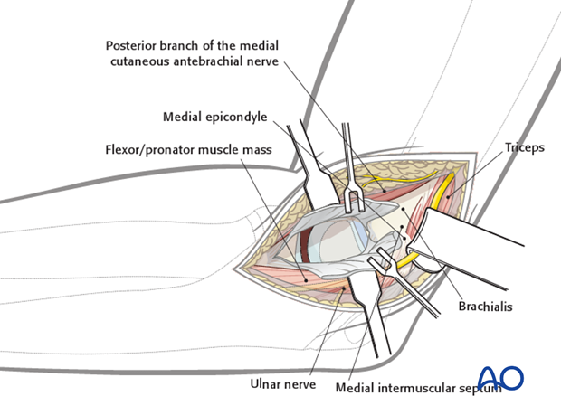 medial approach