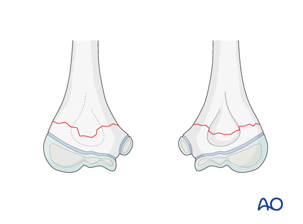 distal humeral surgical and developmental anatomy