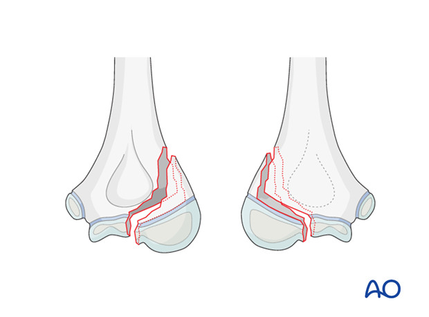 distal humeral surgical and developmental anatomy