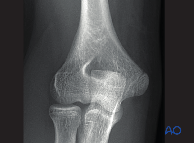 distal humeral surgical and developmental anatomy