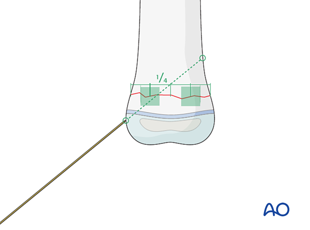 The choice of the entry point must correlate with the planned direction of the K-wire and the end fixation point in the main fragment.