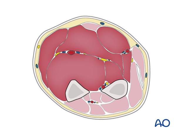 compartment syndrome