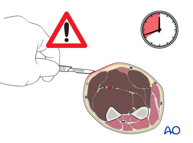 compartment syndrome