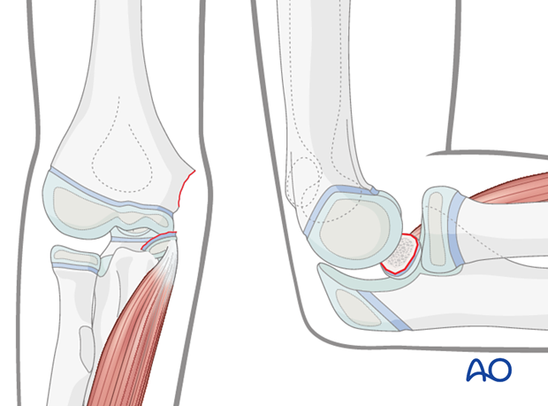 timing of treatment of fractures of the distal humerus