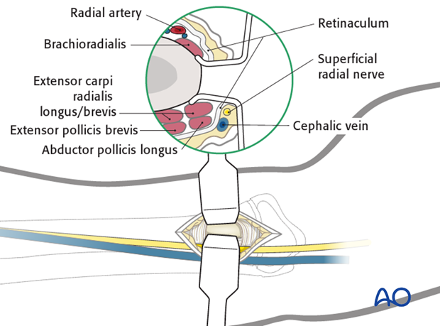 ESIN - Lateral entry point to the radius