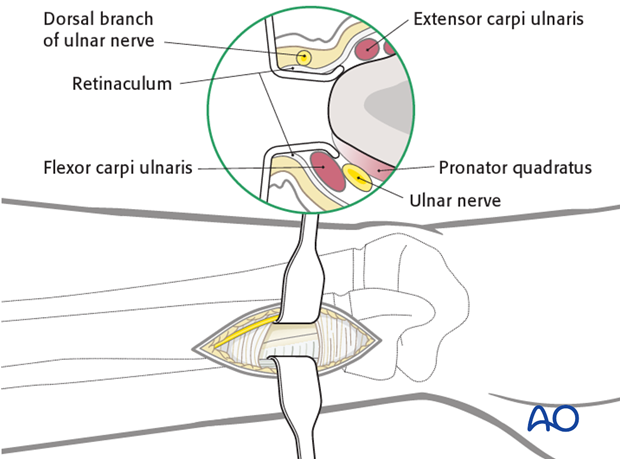 ESIN - Distal medial entry point to the ulna