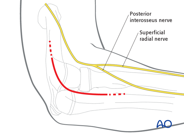 Lateral approach to the proximal radius