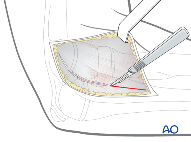 Lateral approach - Superficial surgical dissection