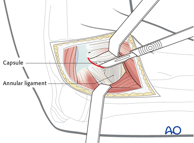 Lateral approach - Deep surgical dissection