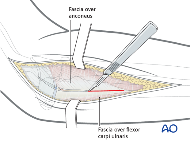 Posterolateral approach - Superficial dissection