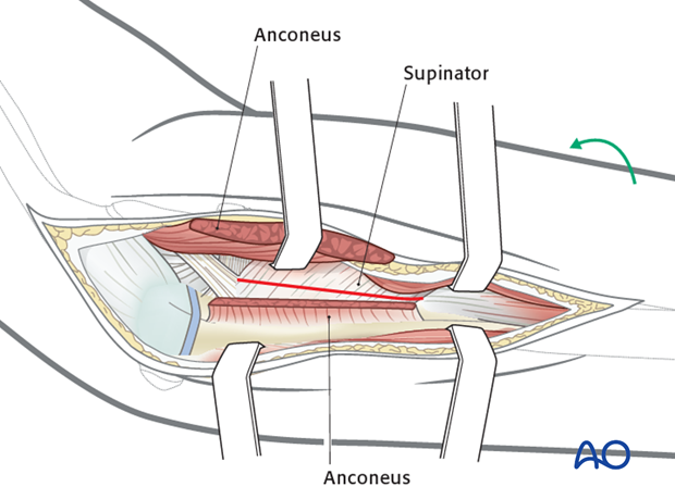 Posterolateral approach - Exposure of radial head/neck