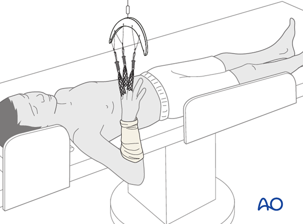 Supine position for casting - Finger traps