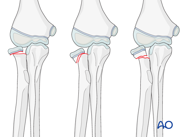 concept of fracture treatment and long term restoration of arm function