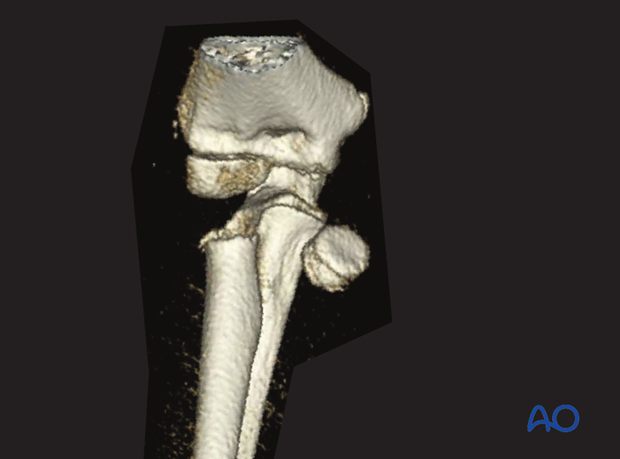 complications of radial head and neck fractures