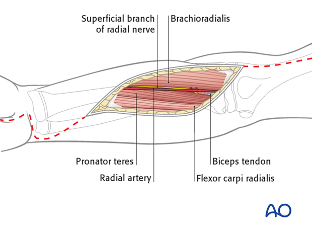 compartment syndrome