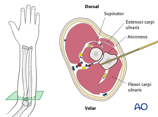 Safe zones for pin placement in the ulna