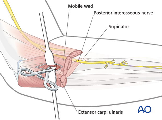 Safe zones for pin placement in the radius