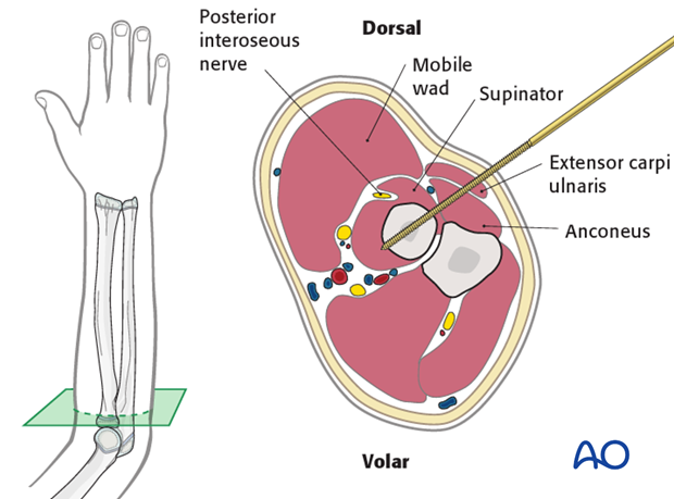 This cross-section illustrates a pin inserted into the proximal 1/3 of the radius.