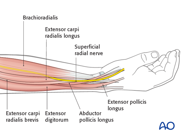 Safe zone in the distal radius