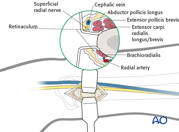 Lateral entry point for the radius