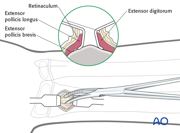 Lister’s tubercle entry point for the radius