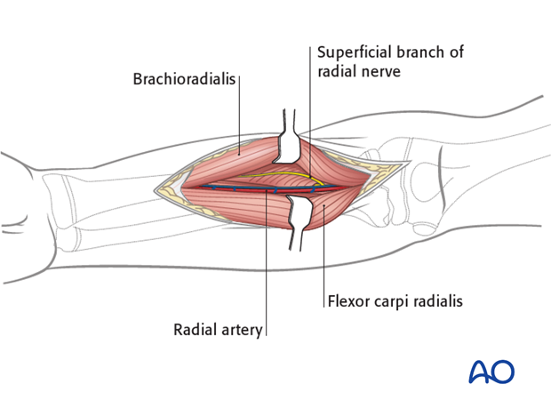 Superficial dissection