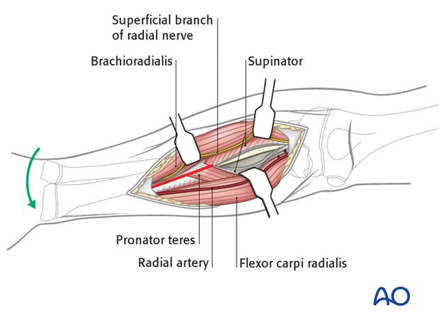 Deep dissection - middle third