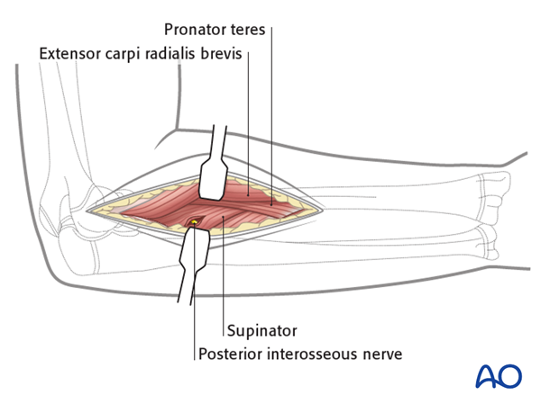 Deep dissection - extension to proximal third