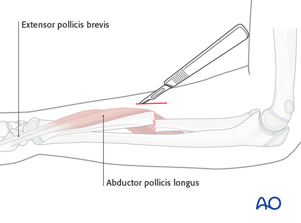 Approach for minimally invasive techniques