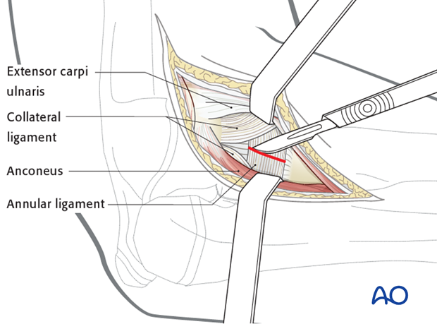 Deep surgical dissection