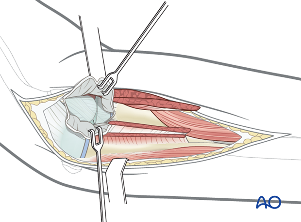 Exposure of radial head/neck