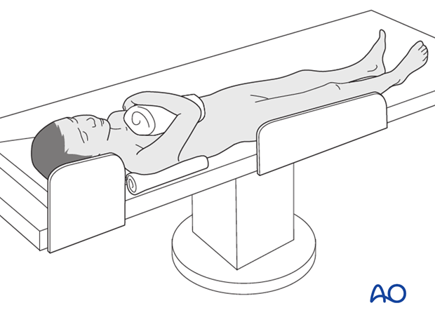 For access to more proximal ulnar shaft fractures, flex the elbow and pin it over the child’s chest.