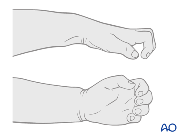 compartment syndrome