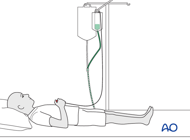 compartment syndrome