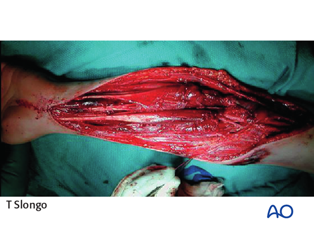 compartment syndrome